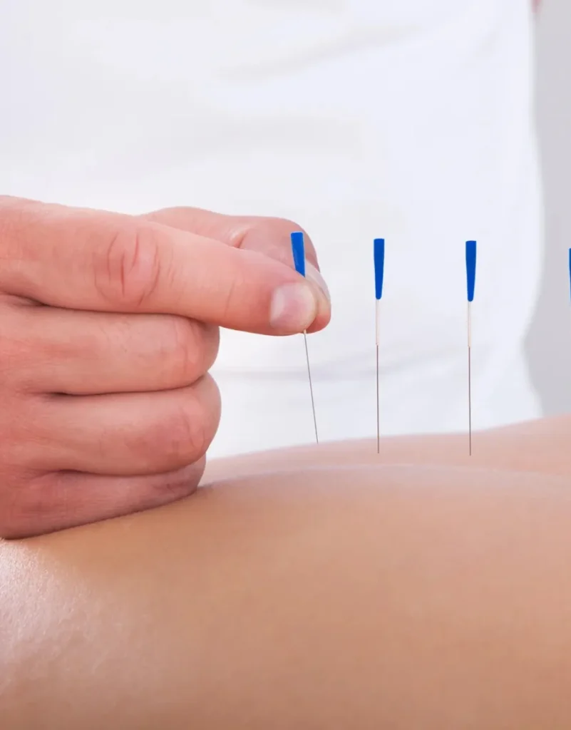 Acupuncture