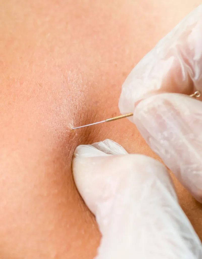 dry needling therapy
